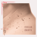 Eliminación de Acrocordones